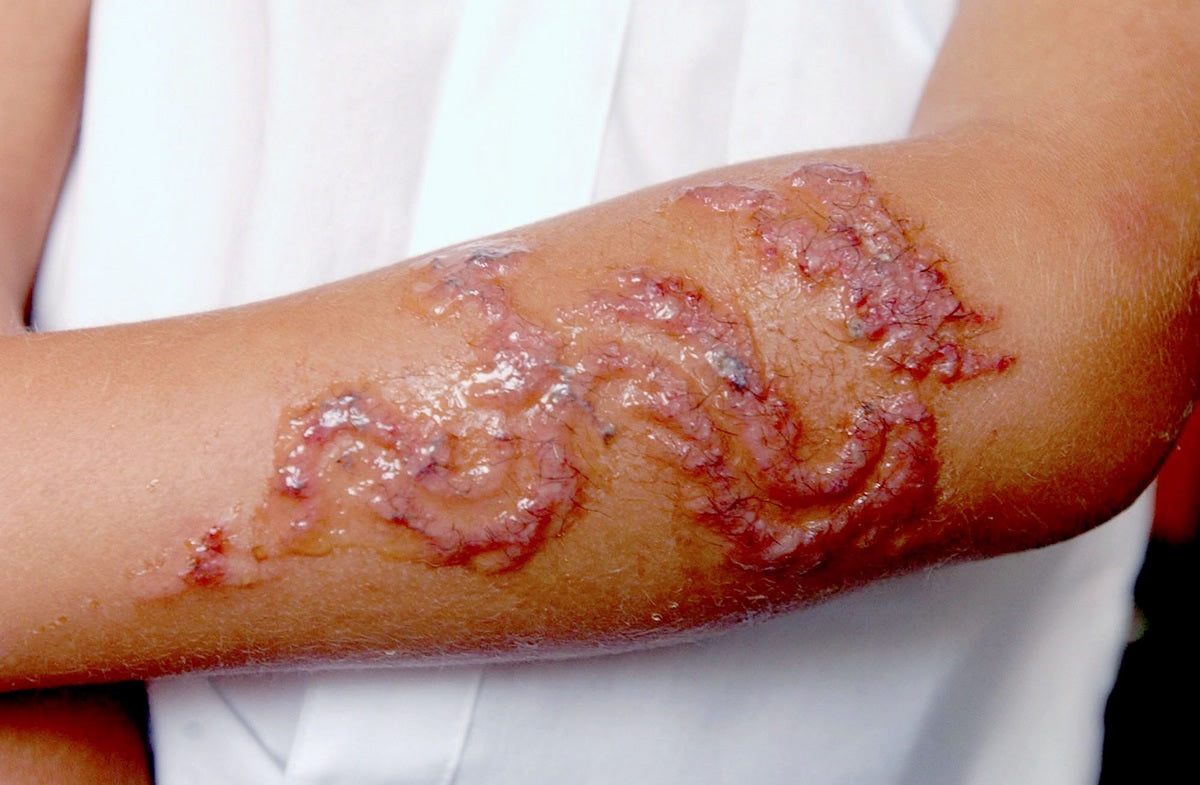 Picture of a severely blistered arm caused by black henna.